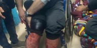 إصابة صحفي برصاص قناص إسرائيلي جنوب وادي غزة